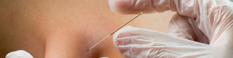 Close-up van een behandelaar die een dunne naald plaatst in de huid tijdens een dry needling behandeling